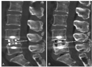 European Radiology：如何预测斜位腰椎椎间融合术后的椎体沉降？