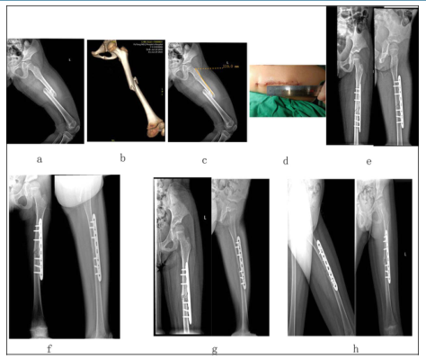 J Am Acad Orthop Surg Glob Res Rev：新型钢板接骨应用技术治疗肢体 