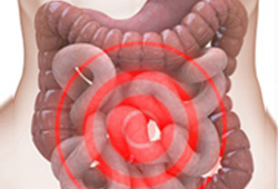 Clin Nutr：替度鲁<font color="red">肽</font>用于克<font color="red">罗</font>恩病术后家庭肠外支持的伴肠衰竭的短肠综合征患者的短期临床评估