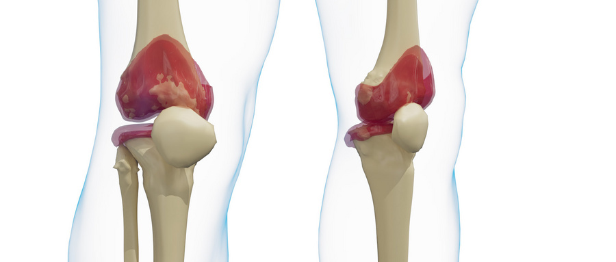 Lancet Rheumatol：<font color="red">术前</font>非手术治疗为膝关节置换患者带来生活质量的显著改善！