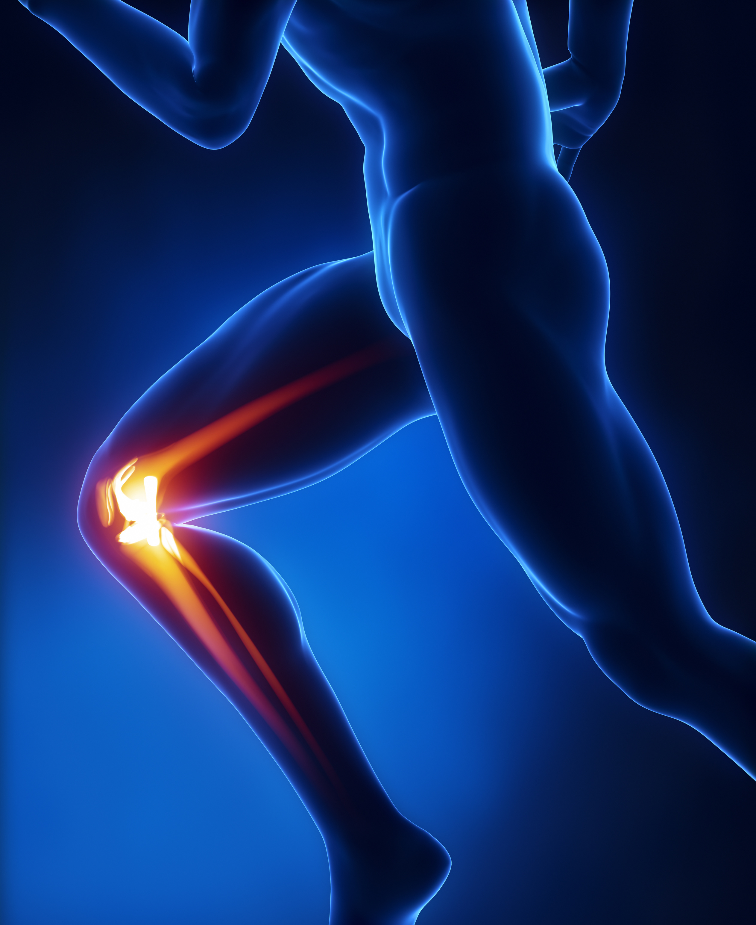  Arthritis Rheumatol：前十字韧带重建患者与轻度膝骨关节炎患者步态差异的发现及其干预潜力