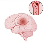 Stroke：血<font color="red">LDL-c</font>、缺血性卒中和小血管疾病脑成像生物标志物的孟德尔随机化研究