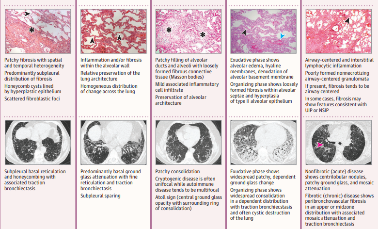 JAMA：肺间质性疾病综述@MedSci