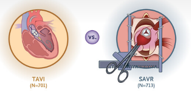 NEJM：主动脉瓣狭窄患者经导管或手术治疗比较