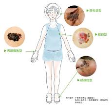 2025 WHO：首選侵入性非傷寒沙門氏菌疫苗的產品特性