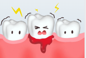 Clin <font color="red">Oral</font> Investig：牙周炎和龋齿之间的关系