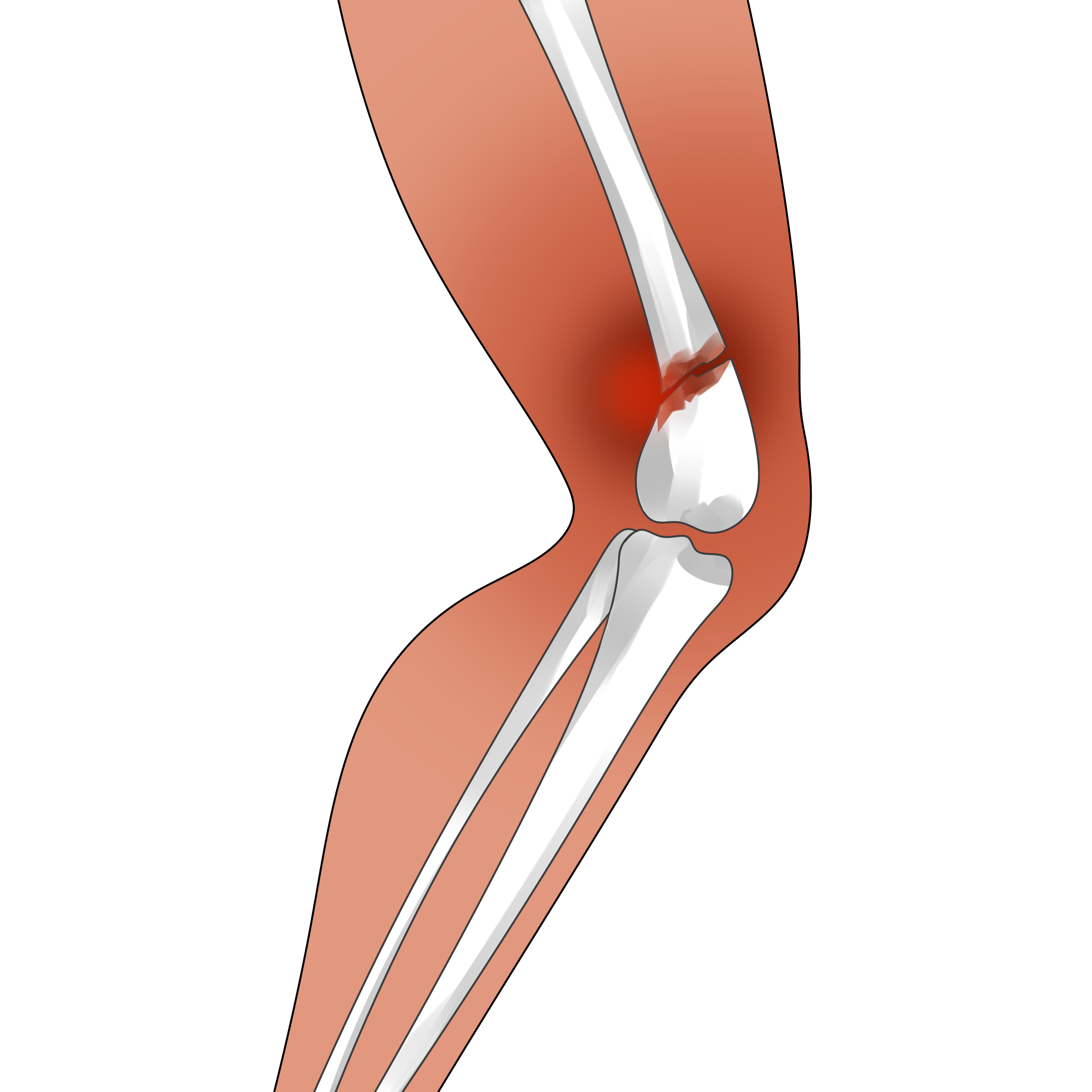 全膝关节假体系统产品注册技术审查指导原则