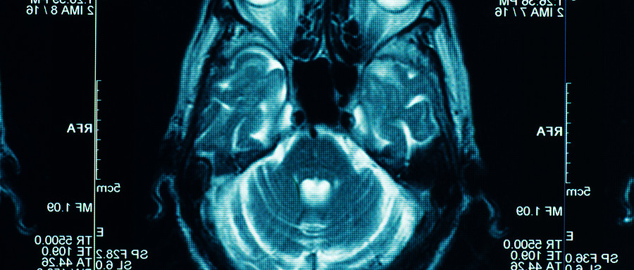 【急诊影像】了解一下外伤后钝性脑血管损伤影像表现及分级