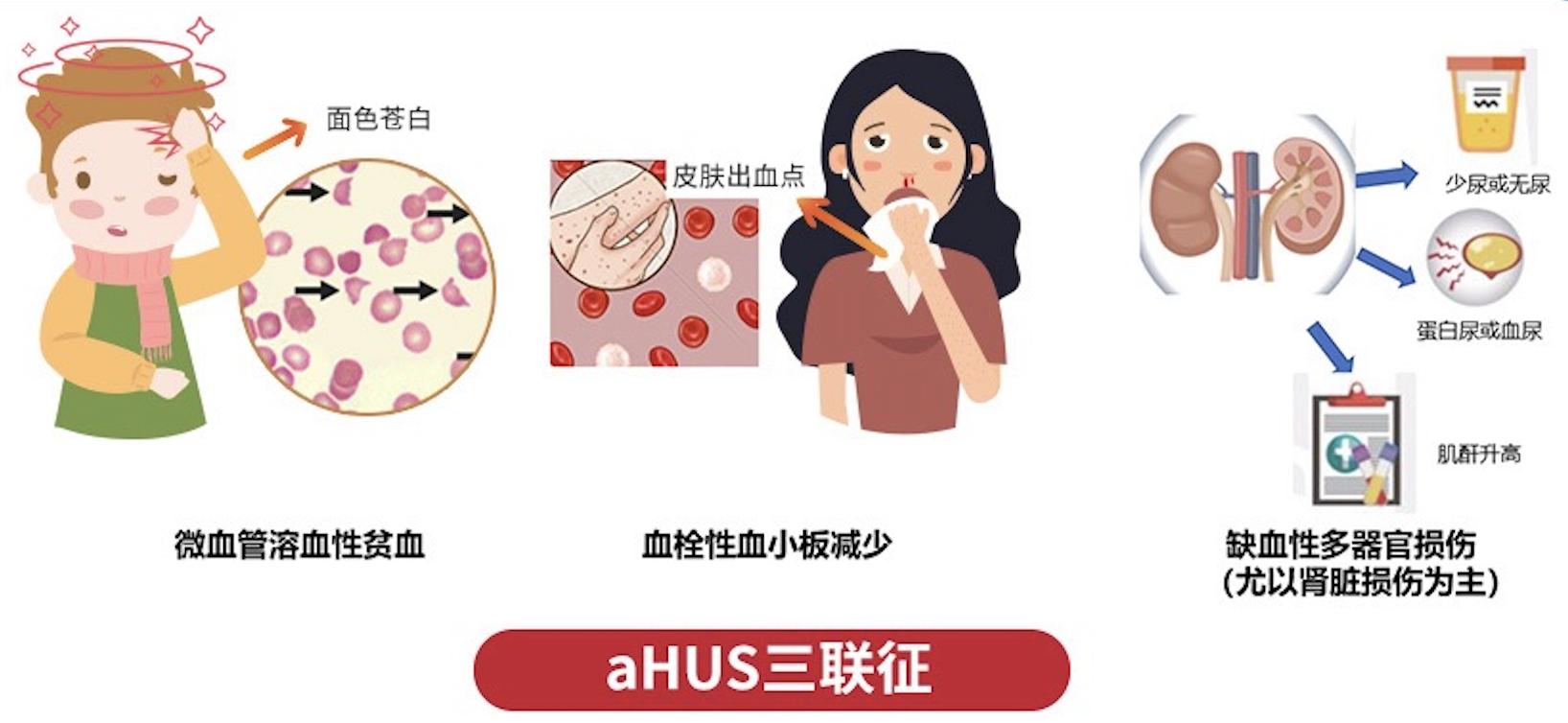 病例分享：非典型溶血性尿毒综合症（<font color="red">aHUS</font>）诊疗1例