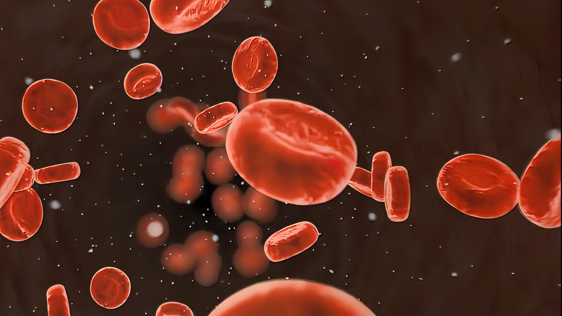 BJH：痰白细胞介素-6水平作为镰状细胞病<font color="red">儿童</font>急性胸部综合征严重程度的标志