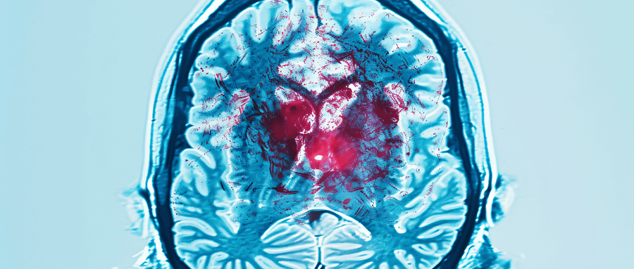 【论著】基于非增强CT的影像组学识别动脉致密征阴性的大脑中动脉闭塞的初步研究