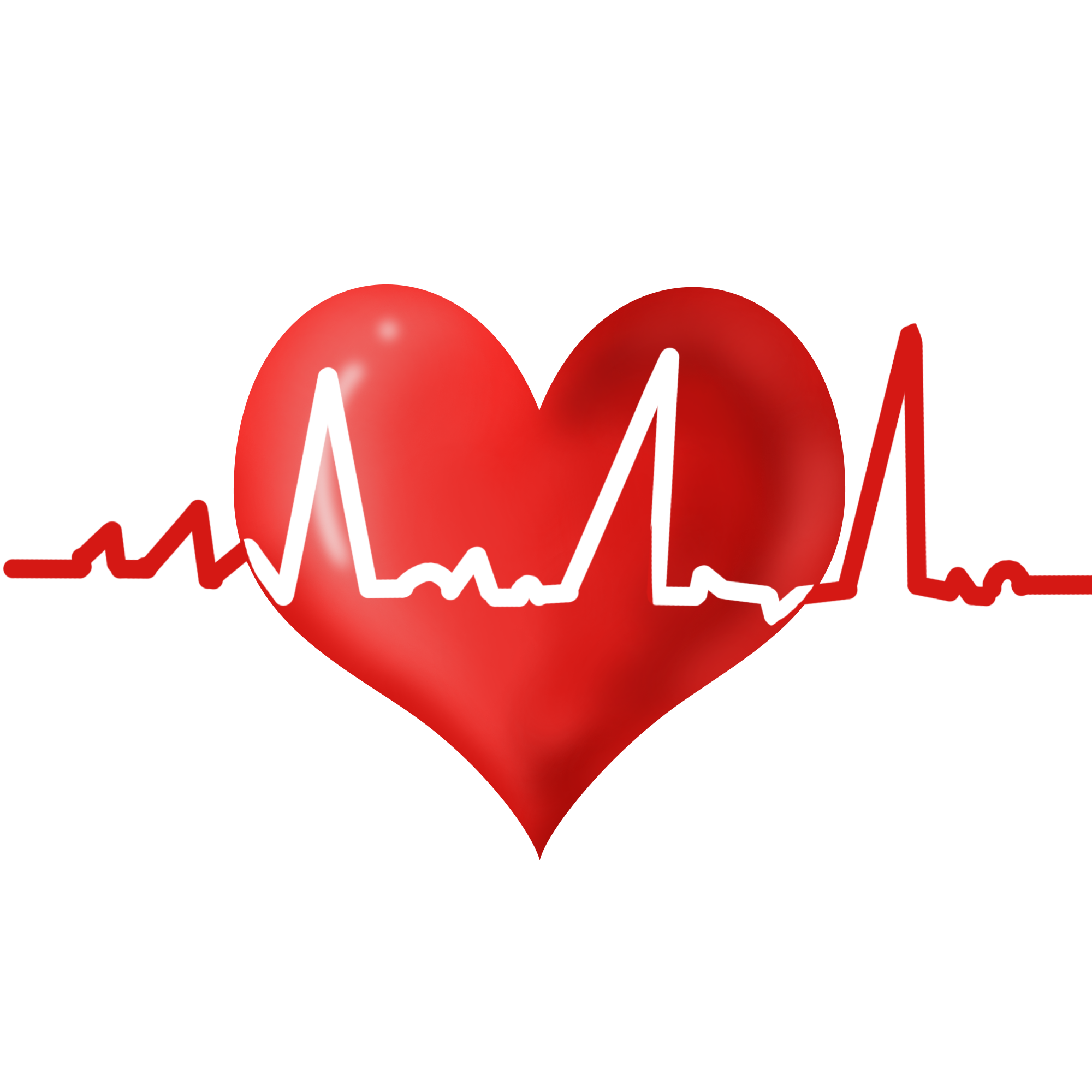 Heart：ST段抬高型心肌梗死的冠状动脉内溶栓疗效分析