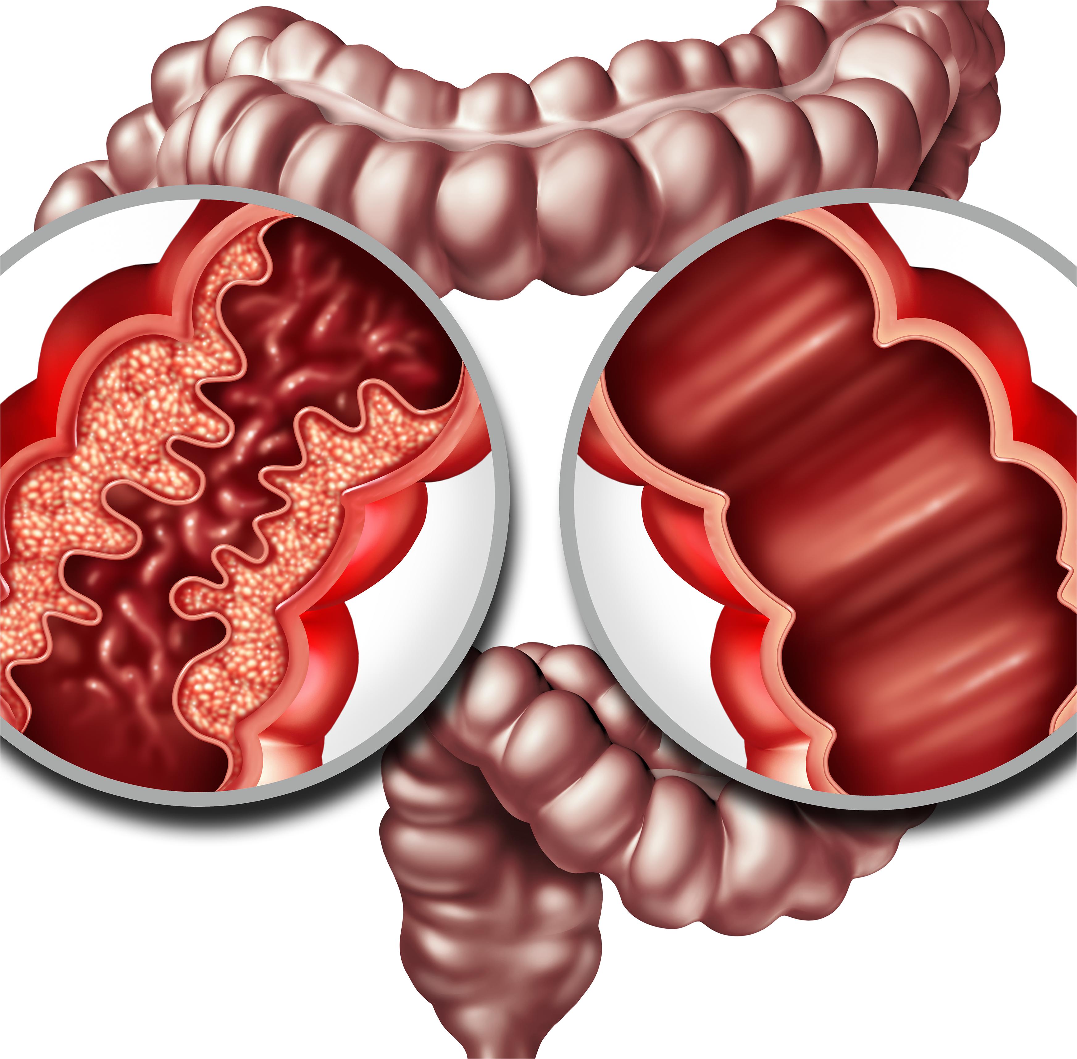 eGastroenterology：<font color="red">孟德尔</font><font color="red">随机化</font>在肠道疾病中的实践