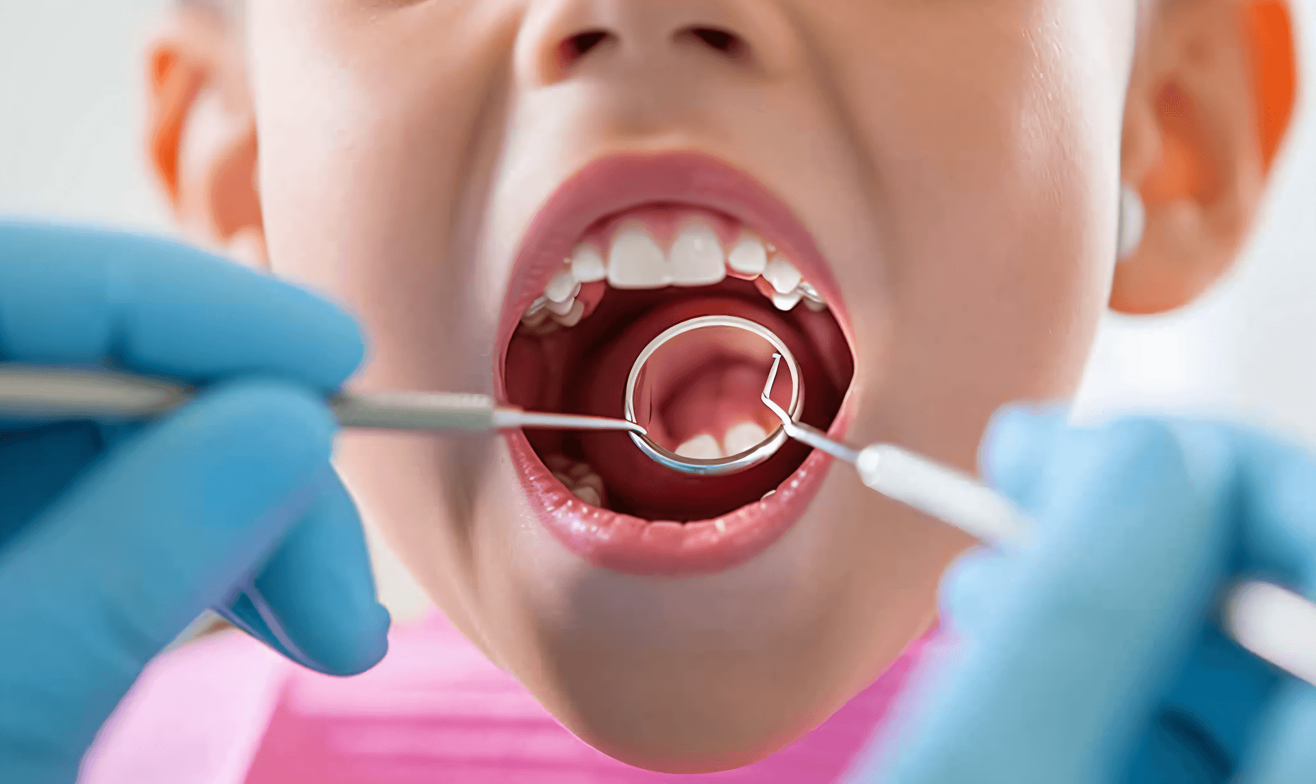 J Dent：糖<font color="red">替代品</font>对儿童和青少年恒牙龋齿预防的效果