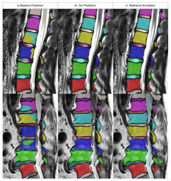 European Radiology：使用两阶段方法对T2加权MR图像进行多类语义和实例分割的全脊柱自动分割