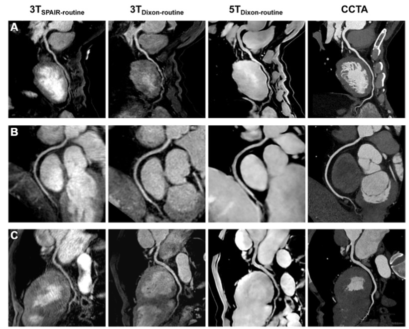 Radiology ：5-T Dixon全心冠状动脉MR血管造影的可行性及临床应用