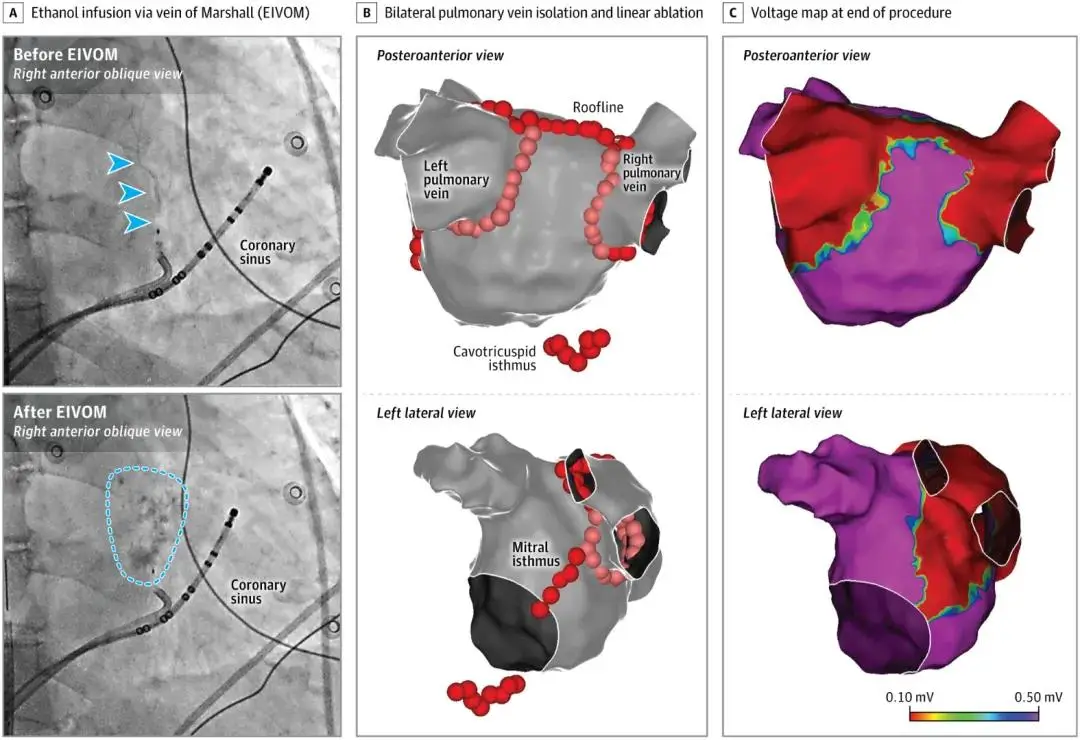 JAMA：桑才華/蔣晨陽(yáng)/董建增/馬長(zhǎng)生團(tuán)隊(duì)研究發(fā)現(xiàn)房顫導(dǎo)管消融<font color="red">改良</font>2C3L術(shù)<font color="red">式</font>明顯優(yōu)于PVI（PROMPT-AF研究）