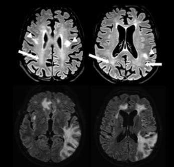 Annals of neurology | 中枢神经系统血管内淋巴瘤的临床和影像学特征：一项多中心队列研究