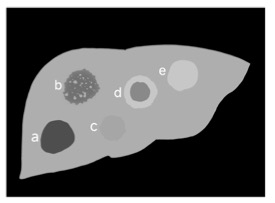 European Radiology:化疗后新出现的<font color="red">肝脏</font>良性局灶性<font color="red">病灶</font>的MRI表现