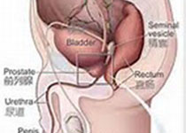 World J Urol：局部治疗后进行挽救性根治性前列腺切除术的手术及肿瘤学结局