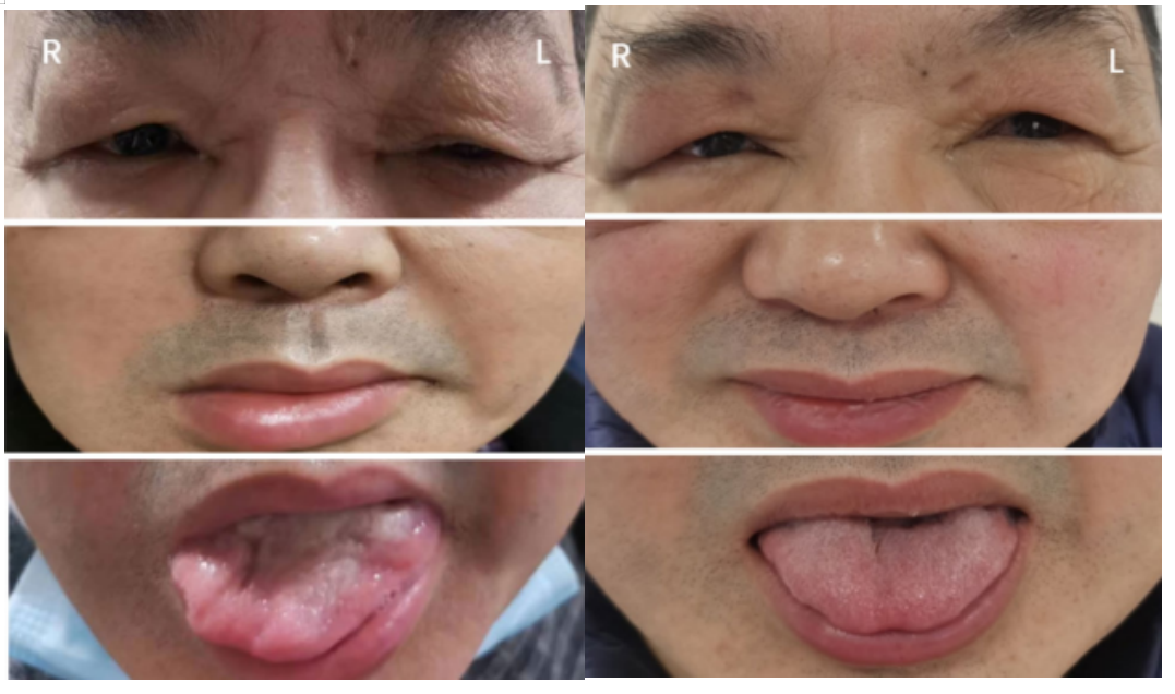 多发性颅神经炎合并霍纳综合征：吉兰-巴雷综合征的一种罕见变异
