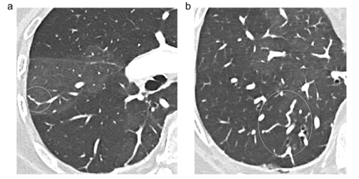 European Radiology：慢性血栓栓塞性肺動脈高壓的肺微血管病變CT高分辨率表現(xiàn)