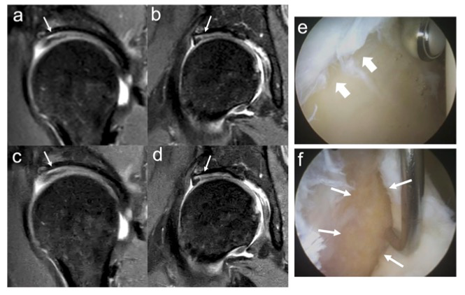 European Radiology：深度學(xué)習(xí)和常規(guī)髖關(guān)節(jié)MRI檢測(cè)唇部和軟骨異常的能力及價(jià)值