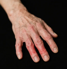 Arthritis Care Res (Hoboken) | 手部骨關(guān)節(jié)炎患者四年疼痛軌跡異質(zhì)性：1/3 改善、1/3 惡化，BMI 與心理因素成關(guān)鍵預(yù)測因子