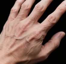 Arthritis Care Res (Hoboken)：現(xiàn)代治療下類風(fēng)濕關(guān)節(jié)炎患者髖部骨折風(fēng)險(xiǎn)增加28%，但長(zhǎng)期死亡率未顯著升高