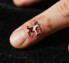 Clin Rheumatol | 系統(tǒng)性硬化癥患者出現(xiàn)指端潰瘍風(fēng)險(xiǎn)高，這三類人群要特別注意：ATA陽性、手指腫脹和疾病活動度高者