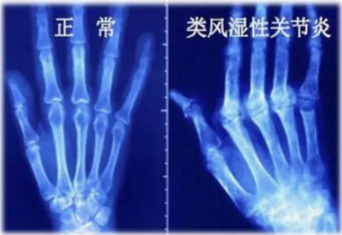 類風(fēng)濕關(guān)節(jié)炎科普考希良教授