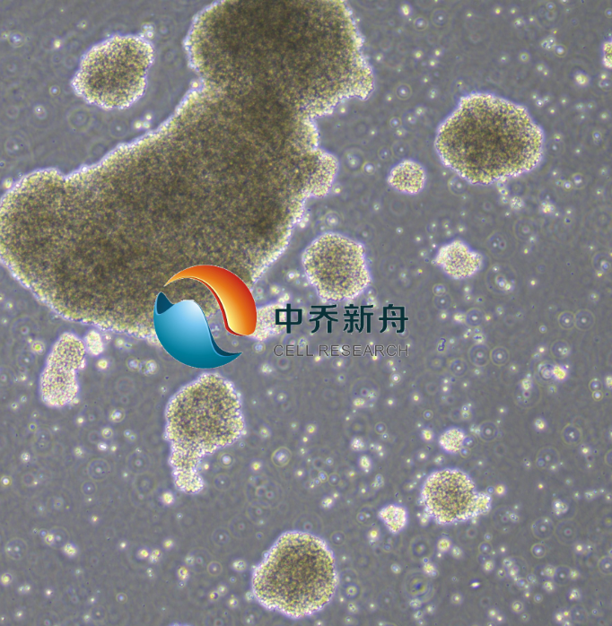 TK原发性中枢神经系统淋巴瘤（STR鉴定）