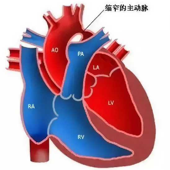 主动脉弓缩窄模型