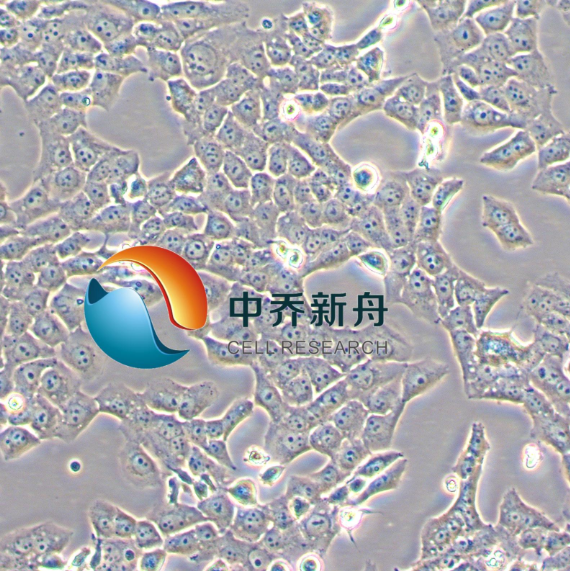 人肺癌大细胞瘤
