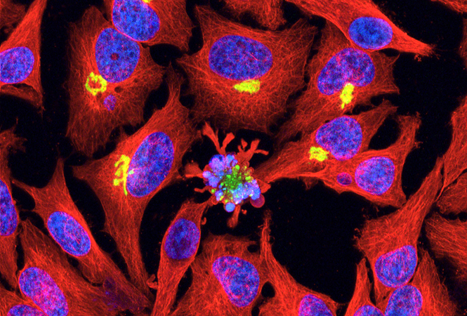 Opdivo/<font color="red">Cabometyx</font>组合疗法用于一线治疗晚期肾癌的III期临床实验成功