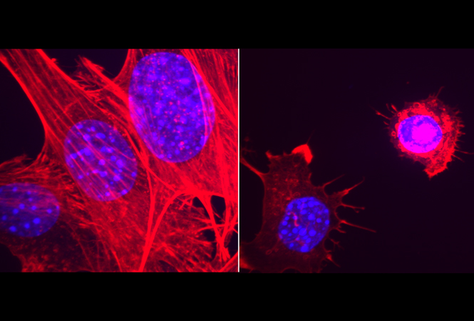 阿斯利康/默克的PARP抑制剂Lynparza延长了转移性去势抵抗性前列腺癌男性的生存期
