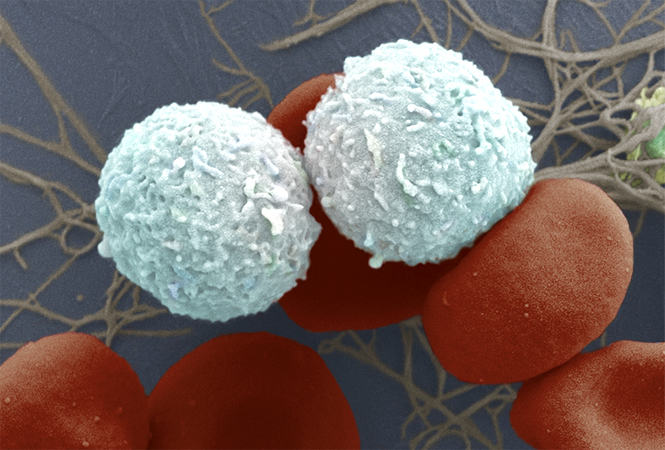Nature Cancer：EZH2抑制重塑炎症性衰老相关的分泌表型从而增强胰腺癌的免疫检测