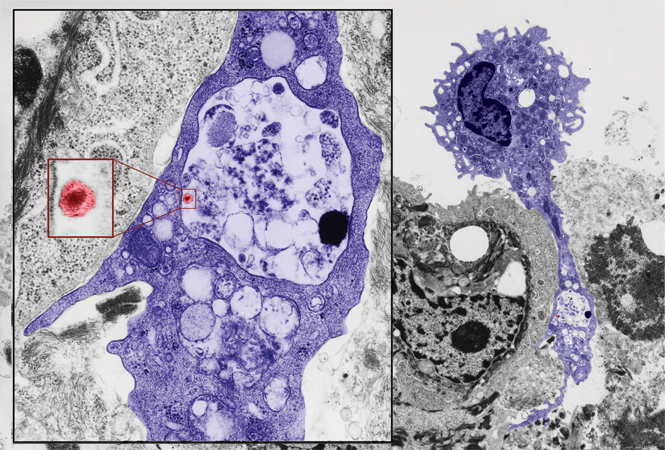 Cell Death Dis：<font color="red">STAT3</font>激活参与TLR4介导的黑色素瘤发生发展