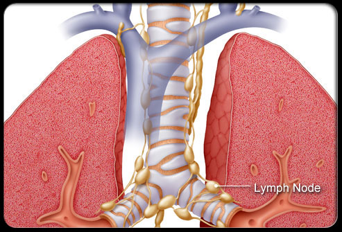 病例分享：典型的囊腔型肺癌又来了！考虑浸润性癌，我们没切肺叶！