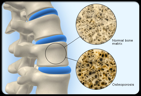 Calcif Tissue Int:骨吸收抑制剂对骨质疏松患者血清胆固醇水平和骨折风险的影响:米诺膦酸和雷洛昔芬的随机比较研究。