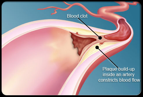 AJC：静脉血栓栓塞后肺动脉高压的长期预后影响