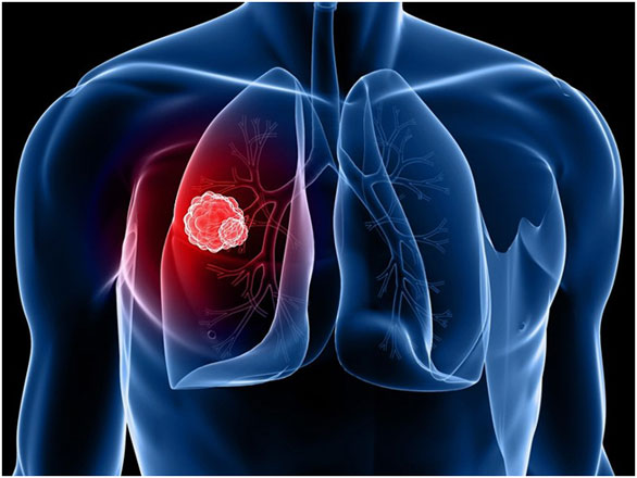 肺癌新疗法！“双特异性疗法”获美国FDA突破性药物资格！