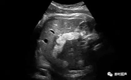 胎儿肠管扩张及回声增强