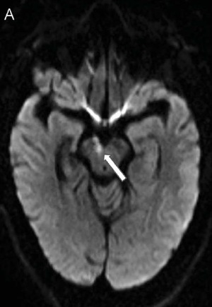 Neurology：大脑脚梗死引起的部分动眼神经麻痹