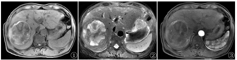 MRI不典型肝细胞肝癌1例