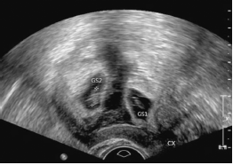 超声诊断剖宫产瘢痕妊娠合并宫内妊娠1例