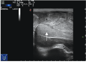 睾丸旁胚胎性横纹肌肉瘤超声表现1例