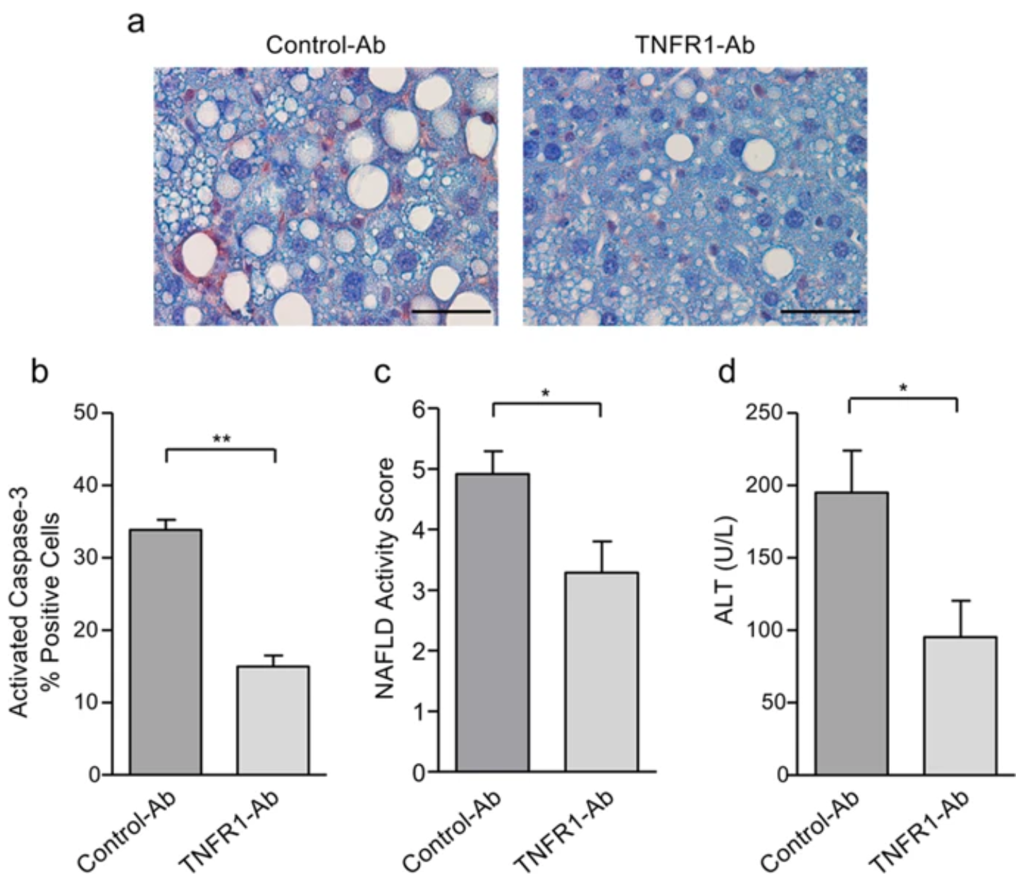 Cell Death Dis：TNFR1或可作为非酒精性脂肪肝的治疗靶点