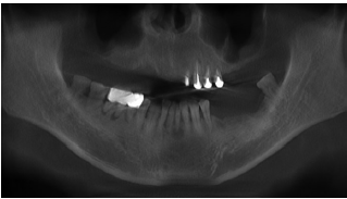 套筒冠<font color="red">精密</font>附着体联合磁性附着体的覆盖义齿修复上颌牙列缺损1例报告