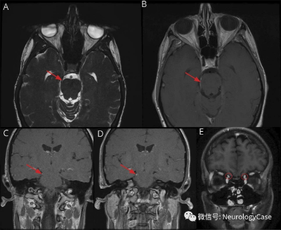 Neurology：病例: 滑车神经施旺细胞<font color="red">瘤</font>（神经鞘<font color="red">瘤</font>）